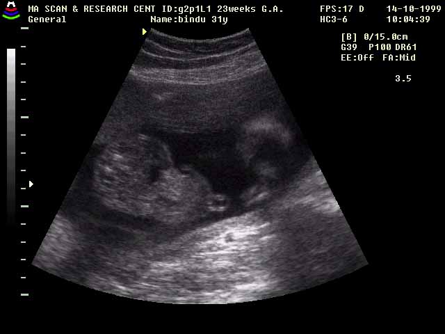 Omphalocele, An Ultra Sound Teaching File